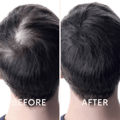 Seurico™ | hårbotten återuppliva laserterapi enhet